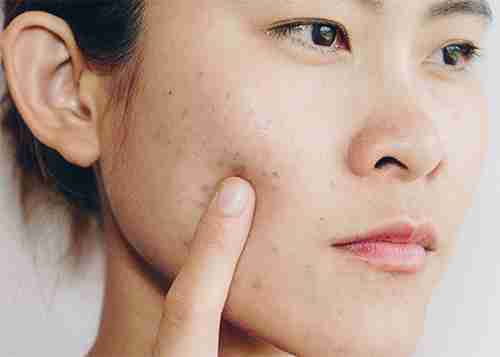 Acne Scar