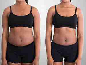 Before After Body slimming