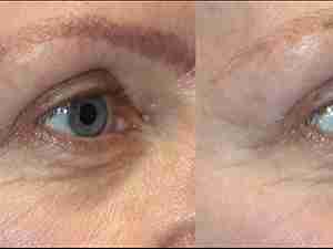Before After Eyes area treatments