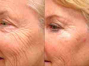 Before After Face wrinkle removal