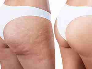 Before After Fat and cellulite reduction