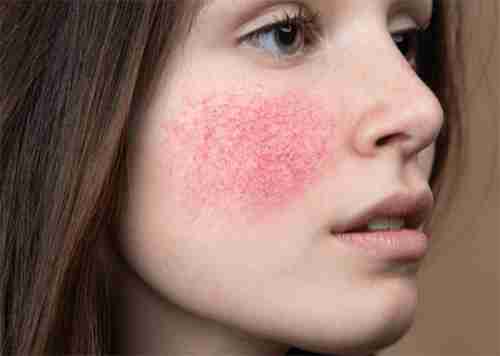 Vascular Lesions