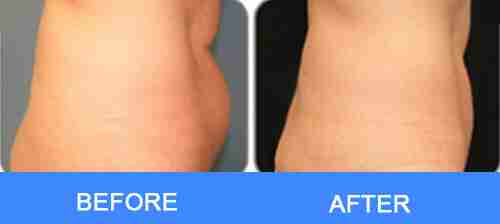 laser Waist fat removal