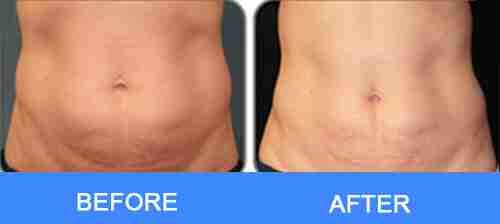 laser abdomen fat remvoal