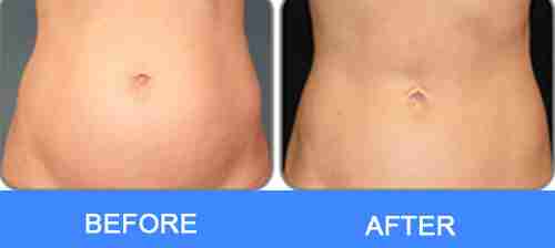 laser belly fat removal before after picture